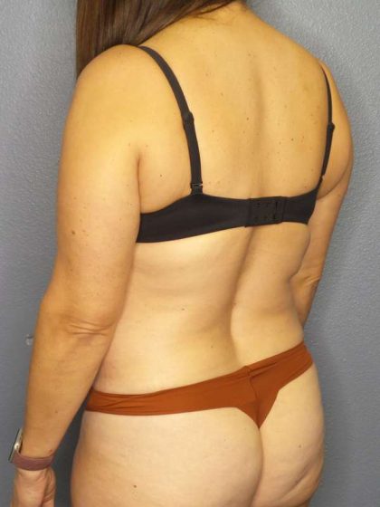 Liposuction Female Before & After Patient #8001