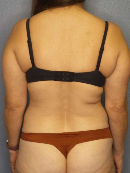 Liposuction Female Before & After Patient #8001