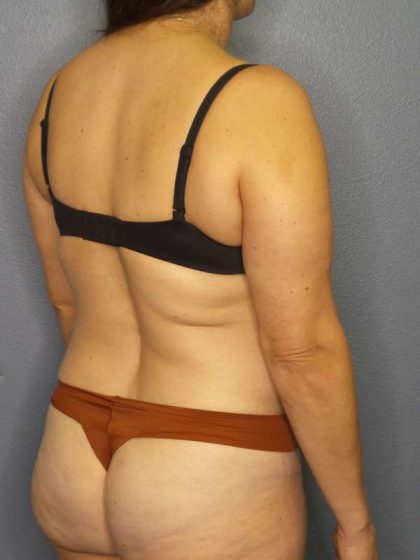 Liposuction Female Before & After Patient #8001
