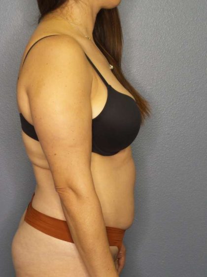 Liposuction Female Before & After Patient #8001