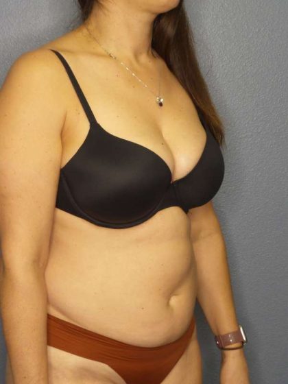 Liposuction Female Before & After Patient #8001