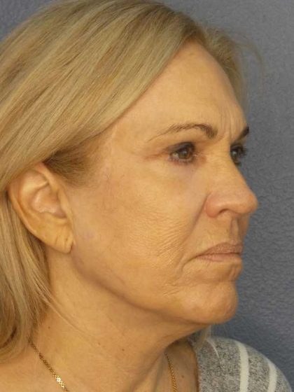 Resurfacing Before & After Patient #9733