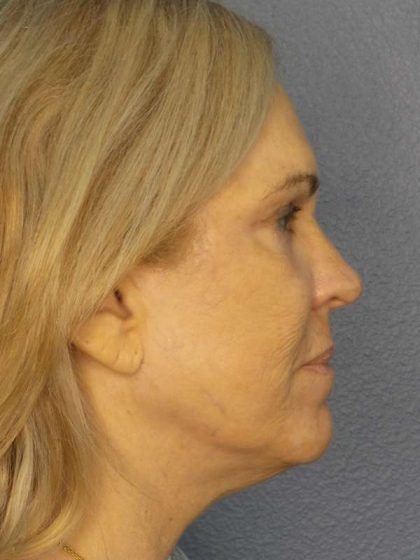 Resurfacing Before & After Patient #9733