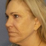Resurfacing Before & After Patient #9733
