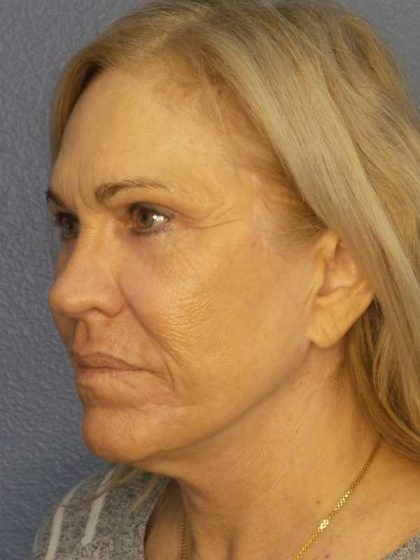 Resurfacing Before & After Patient #9733