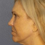 Resurfacing Before & After Patient #9733