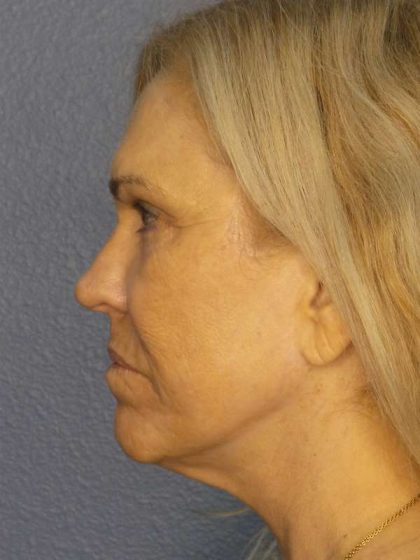 Resurfacing Before & After Patient #9733