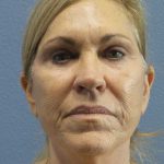 Resurfacing Before & After Patient #9733