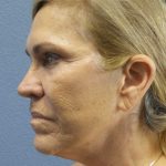Resurfacing Before & After Patient #9733