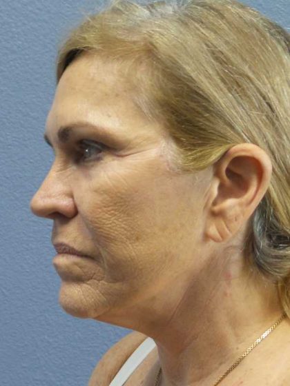 Resurfacing Before & After Patient #9733