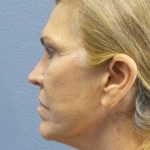 Resurfacing Before & After Patient #9733