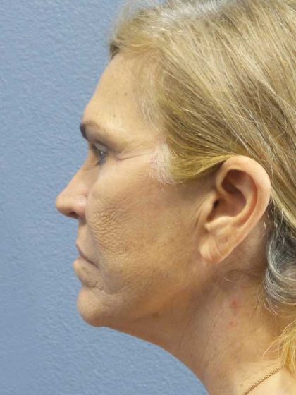 Resurfacing Before & After Patient #9733