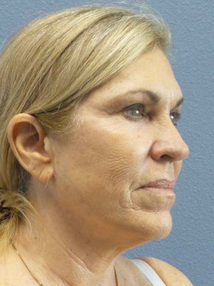 Resurfacing Before & After Patient #9733
