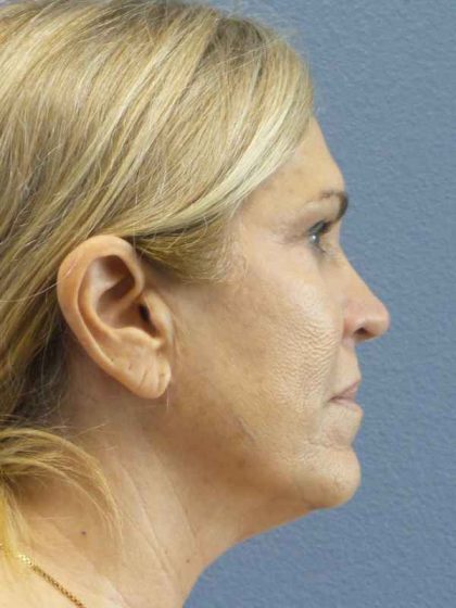 Resurfacing Before & After Patient #9733