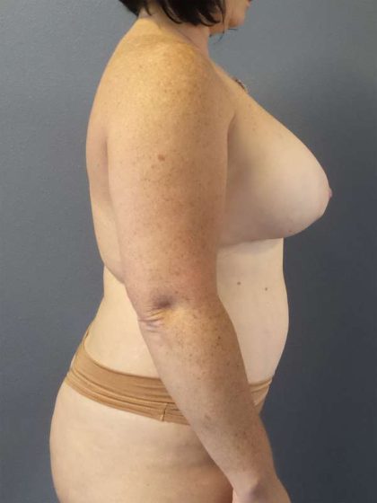High BMI (Larger Patients) Surgery Before & After Patient #10392