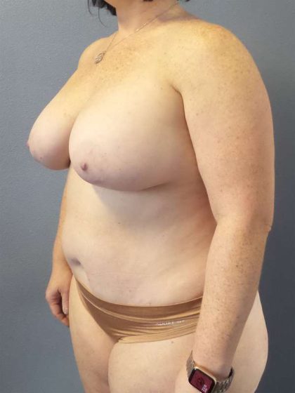 High BMI (Larger Patients) Surgery Before & After Patient #10392
