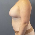 High BMI (Larger Patients) Surgery Before & After Patient #10392