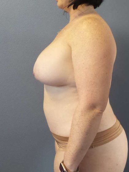 High BMI (Larger Patients) Surgery Before & After Patient #10392