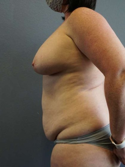 High BMI (Larger Patients) Surgery Before & After Patient #10392