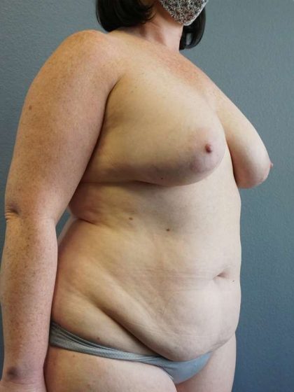 High BMI (Larger Patients) Surgery Before & After Patient #10392