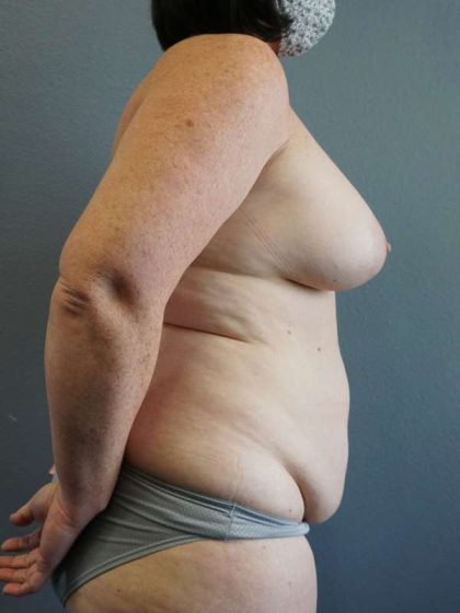 High BMI (Larger Patients) Surgery Before & After Patient #10392