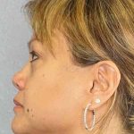 Periorbital Before & After Patient #8591