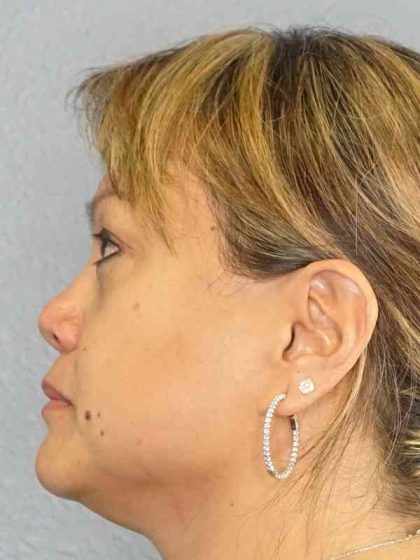 Periorbital Before & After Patient #8591