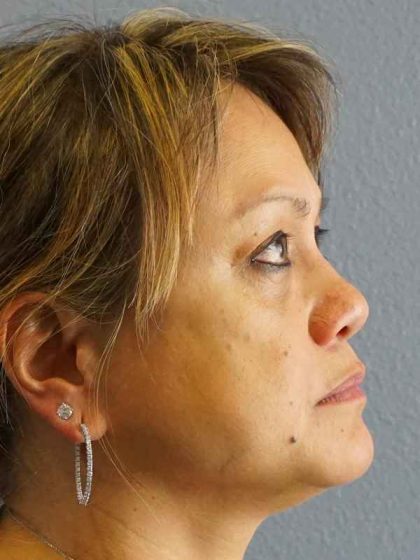 Periorbital Before & After Patient #8591