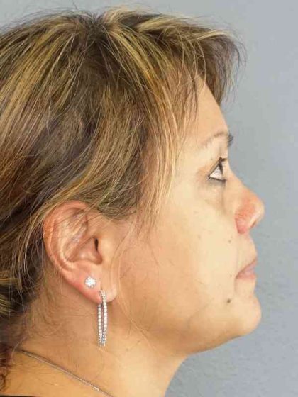 Periorbital Before & After Patient #8591