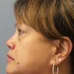 Periorbital Before & After Patient #8591