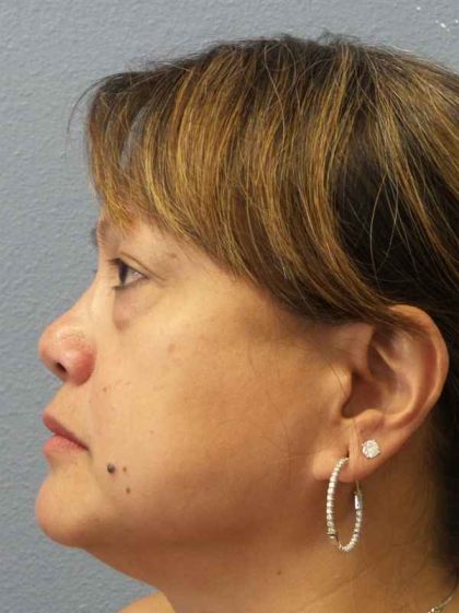 Periorbital Before & After Patient #8591