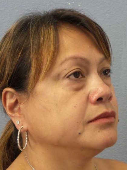 Periorbital Before & After Patient #8591