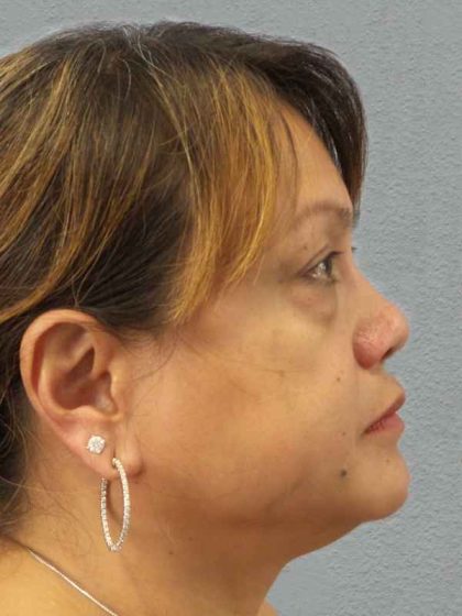 Periorbital Before & After Patient #8591