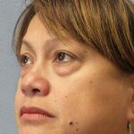 Periorbital Before & After Patient #8591