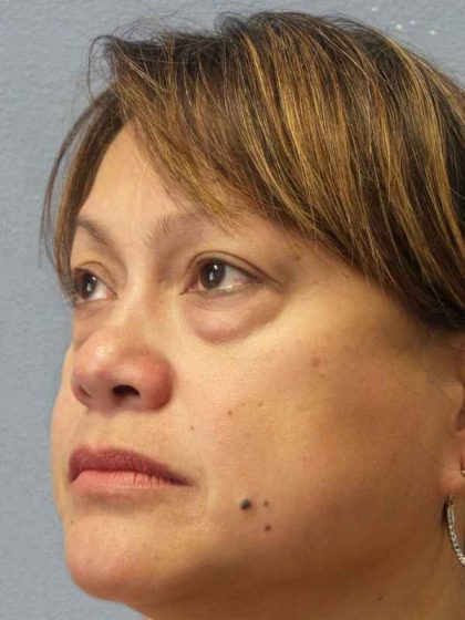 Periorbital Before & After Patient #8591