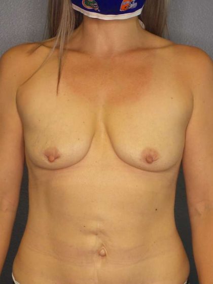 Breast Augmentation Revision (Breast Enlargement Repair) Before & After Patient #7337