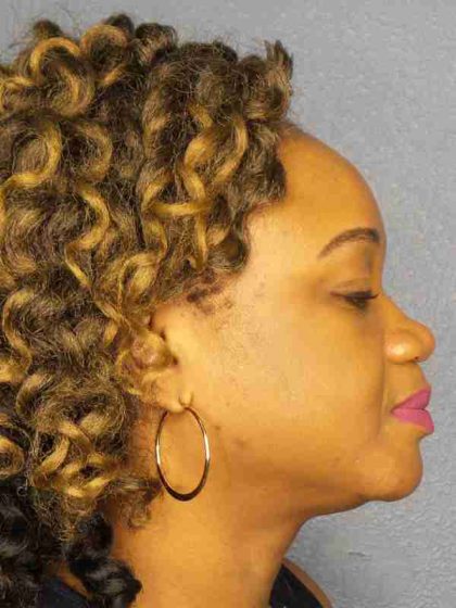 Rhinoplasty Before & After Patient #9940