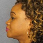 Rhinoplasty Before & After Patient #9940