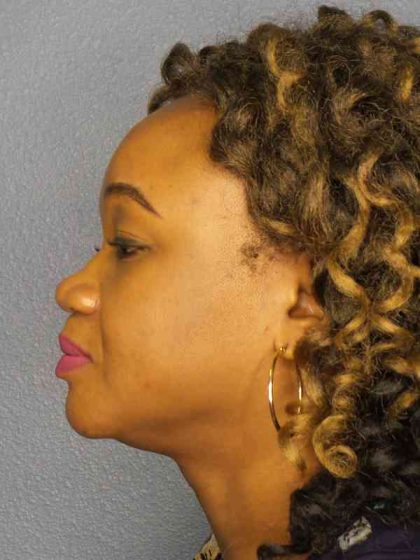 Rhinoplasty Before & After Patient #9940