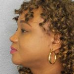 Rhinoplasty Before & After Patient #9940