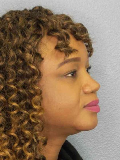 Rhinoplasty Before & After Patient #9940