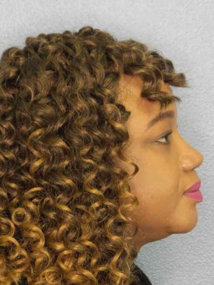 Rhinoplasty Before & After Patient #9940