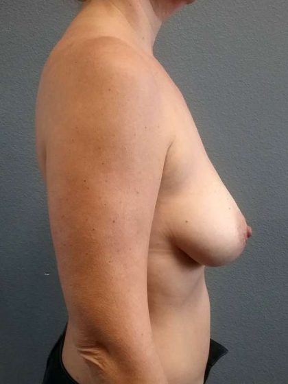 Breast Lift with Implant (Augmentation Mastopexy) Before & After Patient #4314