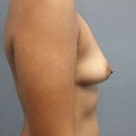 Breast Augmentation Before & After Patient #6108