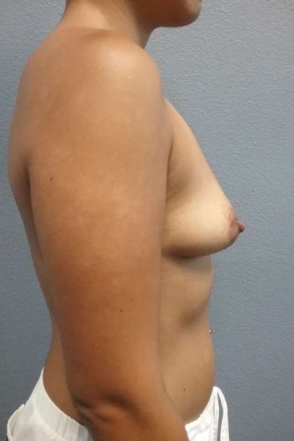 Breast Augmentation Before & After Patient #6108