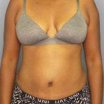 Abdominoplasty Before & After Patient #3665