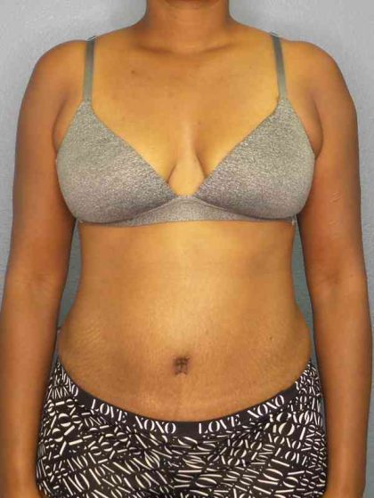 Abdominoplasty Before & After Patient #3665