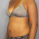 Abdominoplasty Before & After Patient #3665