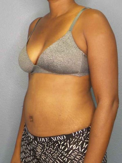 Abdominoplasty Before & After Patient #3665