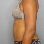 Abdominoplasty Before & After Patient #3665